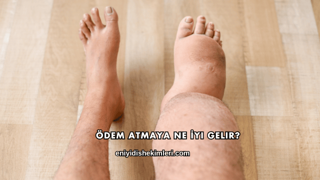 Ödem Atmaya Ne İyi Gelir?