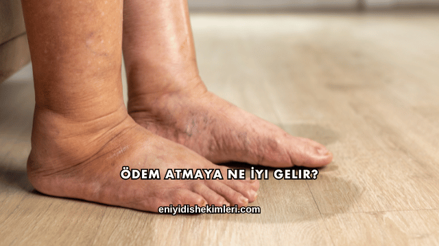 Ödem Atmaya Ne İyi Gelir?