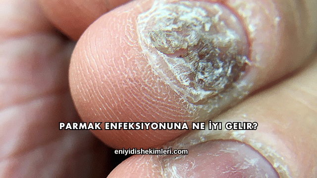 Parmak Enfeksiyonuna Ne İyi Gelir?
