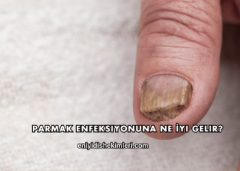 Parmak Enfeksiyonuna Ne İyi Gelir?