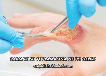 Parmak Su Toplamasına Ne İyi Gelir?