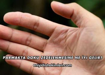 Parmakta Doku Zedelenmesine Ne İyi Gelir?