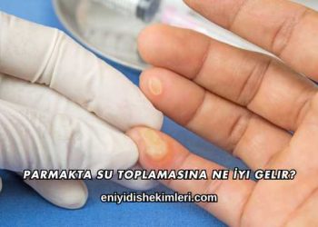 Parmakta Su Toplamasına Ne İyi Gelir?