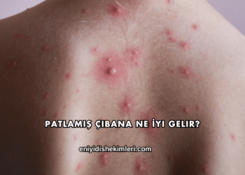 Patlamış Çıbana Ne İyi Gelir?