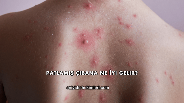 Patlamış Çıbana Ne İyi Gelir?