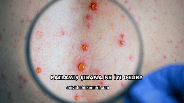 Patlamış Çıbana Ne İyi Gelir?