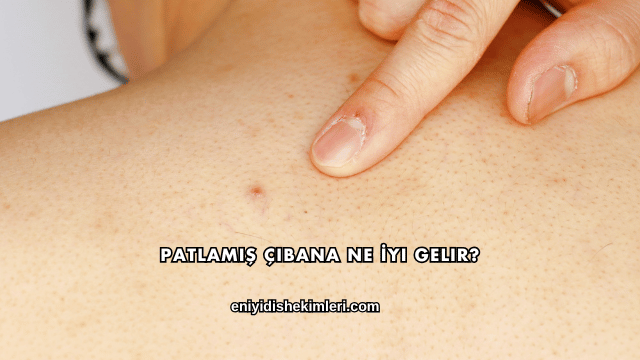 Patlamış Çıbana Ne İyi Gelir?