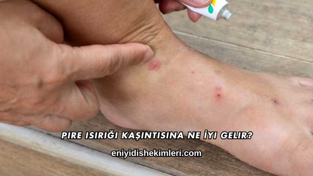Pire Isırığı Kaşıntısına Ne İyi Gelir?
