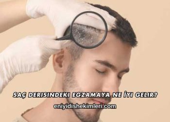 Saç Derisindeki Egzamaya Ne İyi Gelir?