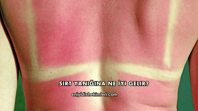 Sırt Yanığına Ne İyi Gelir?