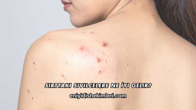 Sırttaki Sivilcelere Ne İyi Gelir?