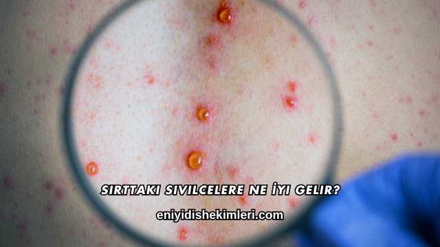 Sırttaki Sivilcelere Ne İyi Gelir?