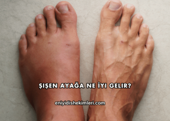 Şişen Ayağa Ne İyi Gelir?
