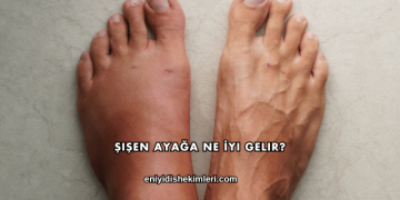 Şişen Ayağa Ne İyi Gelir?