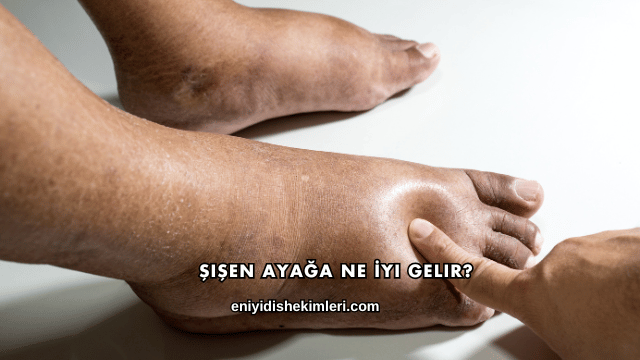 Şişen Ayağa Ne İyi Gelir?