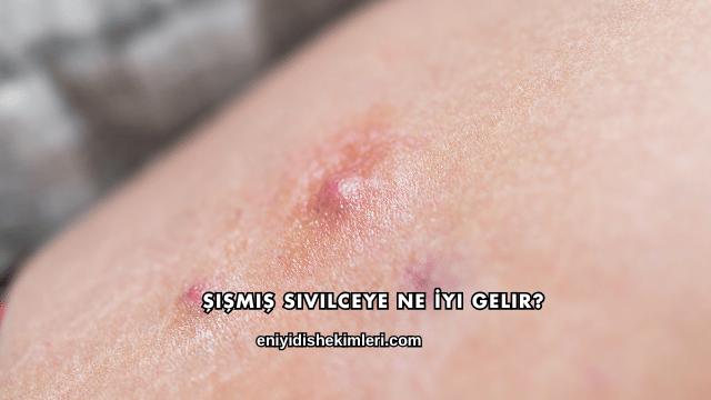 Şişmiş Sivilceye Ne İyi Gelir?