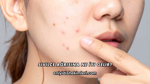 Sivilce Ağrısına Ne İyi Gelir?