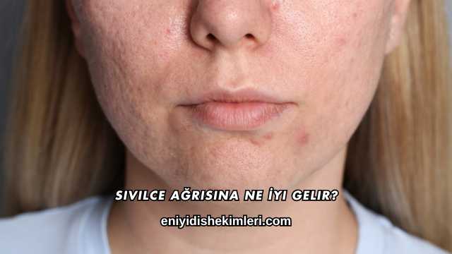 Sivilce Ağrısına Ne İyi Gelir?