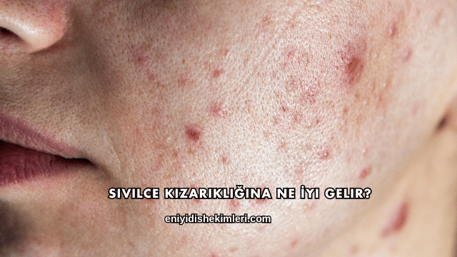 Sivilce Kızarıklığına Ne İyi Gelir?