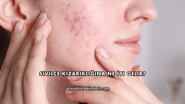 Sivilce Kızarıklığına Ne İyi Gelir?