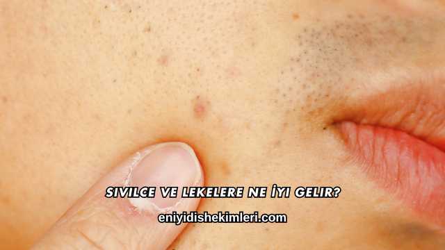 Sivilce ve Lekelere Ne İyi Gelir?