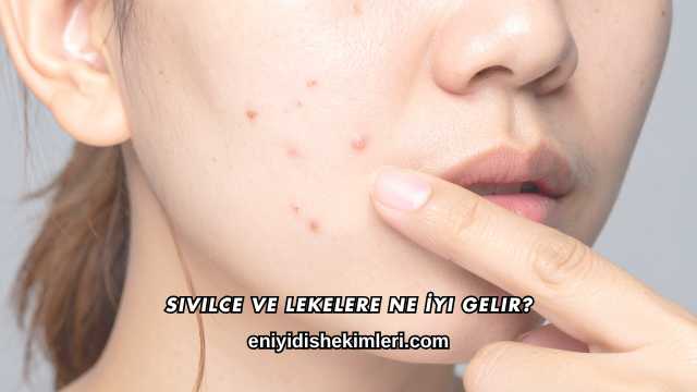 Sivilce ve Lekelere Ne İyi Gelir?