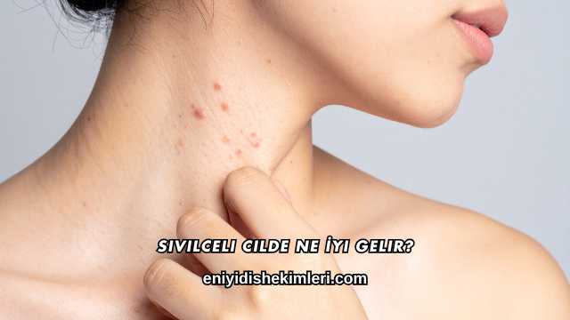 Sivilceli Cilde Ne İyi Gelir?