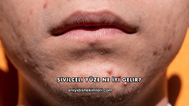Sivilceli Yüze Ne İyi Gelir?