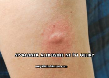 Sivrisinek Alerjisine Ne İyi Gelir?
