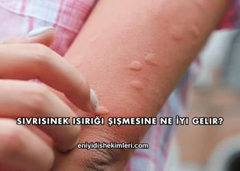 Sivrisinek Isırığı Şişmesine Ne İyi Gelir?