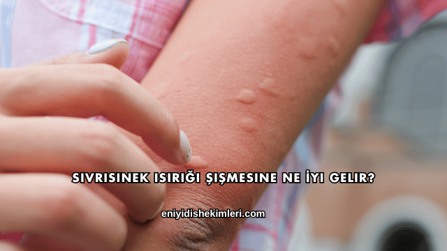 Sivrisinek Isırığı Şişmesine Ne İyi Gelir?