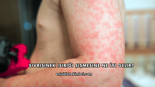 Sivrisinek Isırığı Şişmesine Ne İyi Gelir?