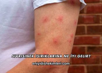 Sivrisinek Isırıklarına Ne İyi Gelir?