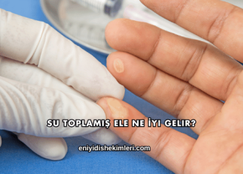 Su Toplamış Ele Ne İyi Gelir?