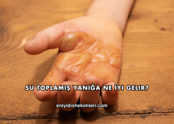 Su Toplamış Yanığa Ne İyi Gelir?