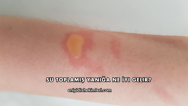 Su Toplamış Yanığa Ne İyi Gelir?