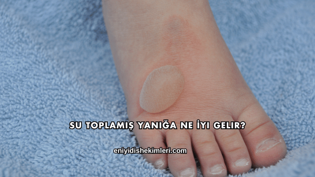 Su Toplamış Yanığa Ne İyi Gelir?