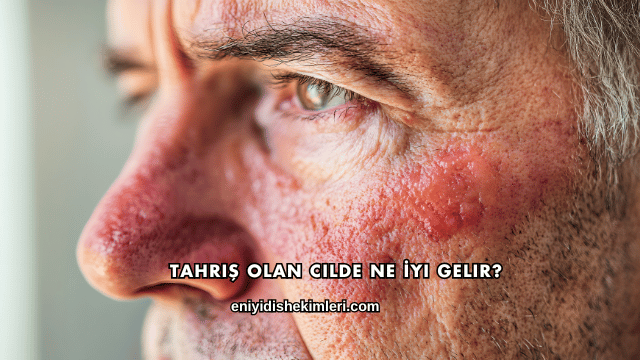 Tahriş Olan Cilde Ne İyi Gelir?