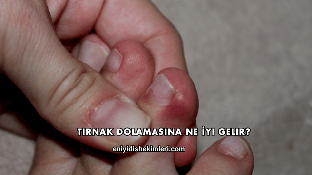 Tırnak Dolamasına Ne İyi Gelir?