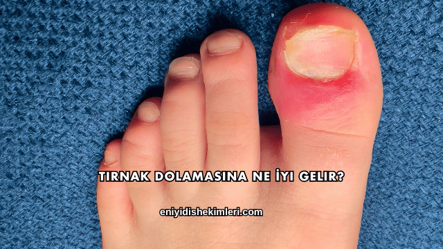 Tırnak Dolamasına Ne İyi Gelir?