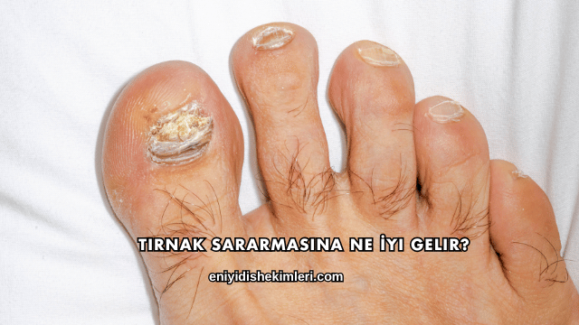 Tırnak Sararmasına Ne İyi Gelir?