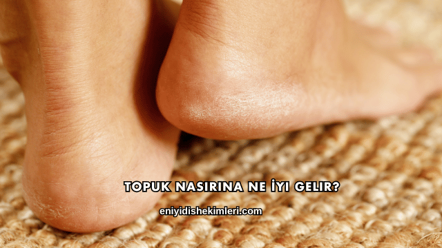 Topuk Nasırına Ne İyi Gelir?