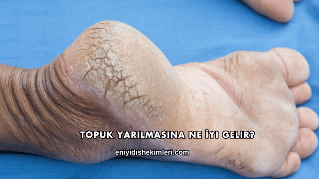 Topuk Yarılmasına Ne İyi Gelir?