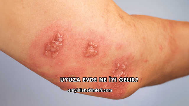 Uyuza Evde Ne İyi Gelir?