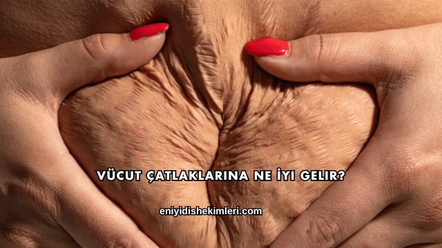 Vücut Çatlaklarına Ne İyi Gelir?