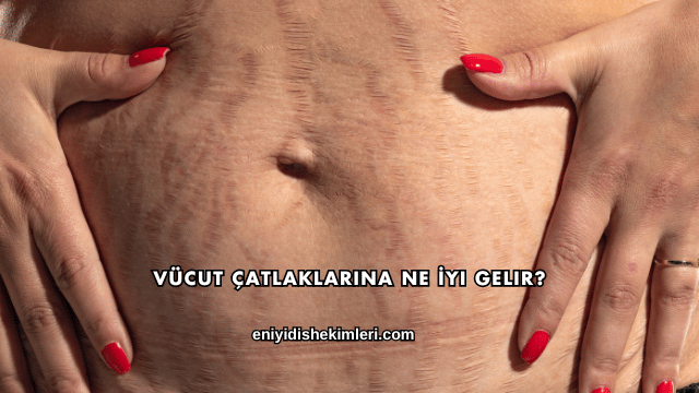 Vücut Çatlaklarına Ne İyi Gelir?