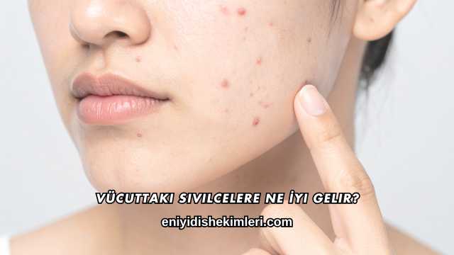 Vücuttaki Sivilcelere Ne İyi Gelir?