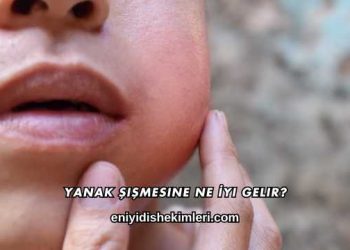 Yanak Şişmesine Ne İyi Gelir?