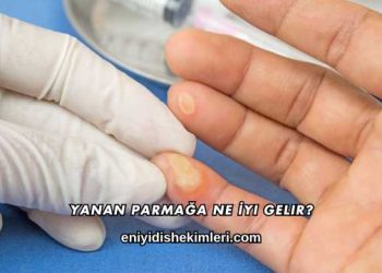 Yanan Parmağa Ne İyi Gelir?