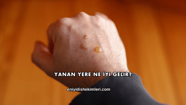 Yanan Yere Ne İyi Gelir?
